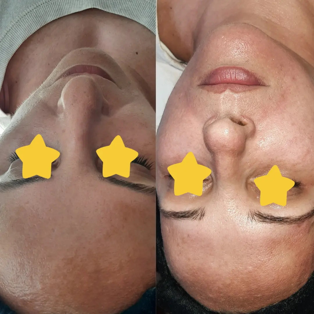 Elin Sary Mary Kutak #beograd Medicinski pedikir Derma Fix tretman lica sa kolagenskim nitima - paket od 3 tetmana