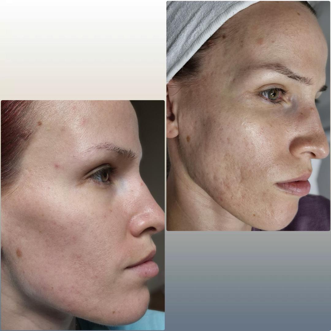 Green see peel tretman lica KRX - IQ aesthetic, Beograd Tretman lica Lice Tretman lica, Beograd, Karaburma, Višnjička banja