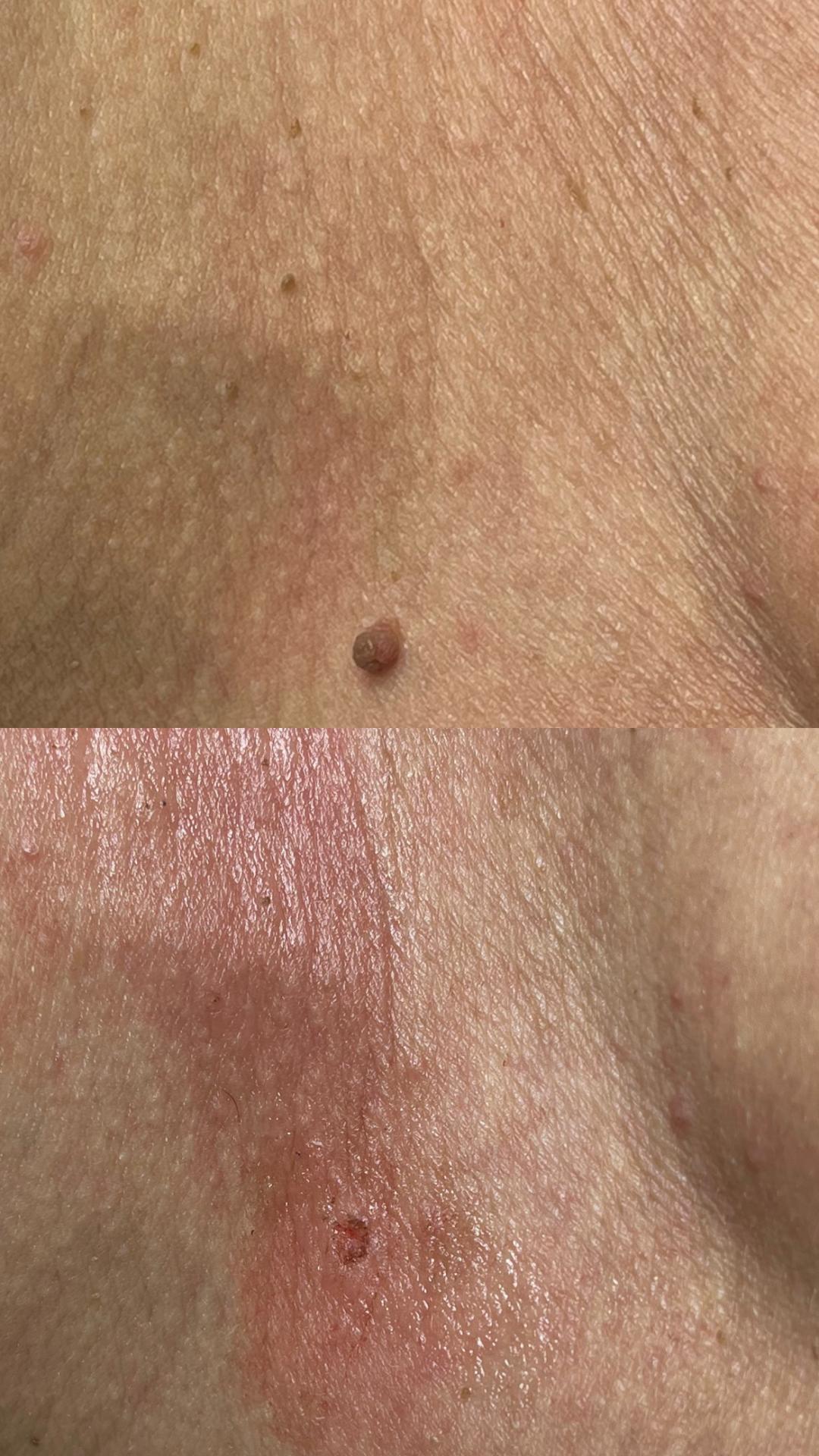 Belle Ana #beograd Tretman lica Phi-Ion tretman - bradavice / papilomi / keratoze / milije / hiperpigmentacija