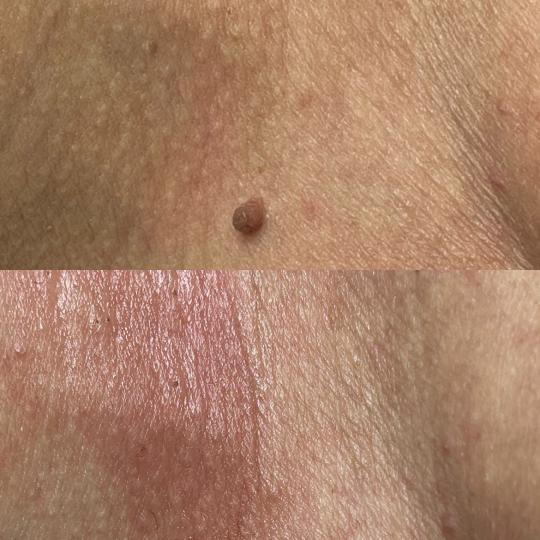 Belle Ana #beograd Tretman lica Phi-Ion tretman - bradavice / papilomi / keratoze / milije / hiperpi