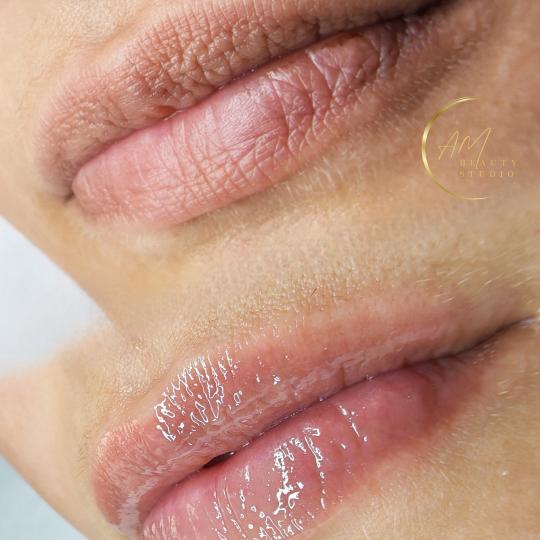 AM BEAUTY STUDIO #odzaci Dermaroler i dermapen HYDRA LIPS