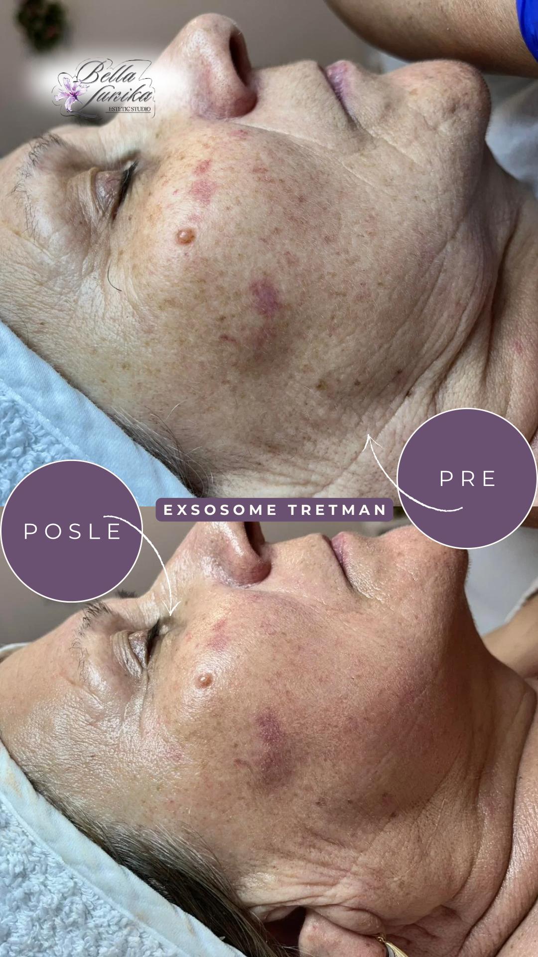 Exoxomes - nature skin - Bella Lunika Estetic studio, Pančevo Tretman lica Lice Tretman lica, Pančevo, Centar