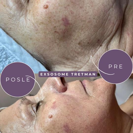 Bella Lunika Estetic studio #pancevo Tretman lica Exoxomes - nature skin Biljni egzozomi i matične 