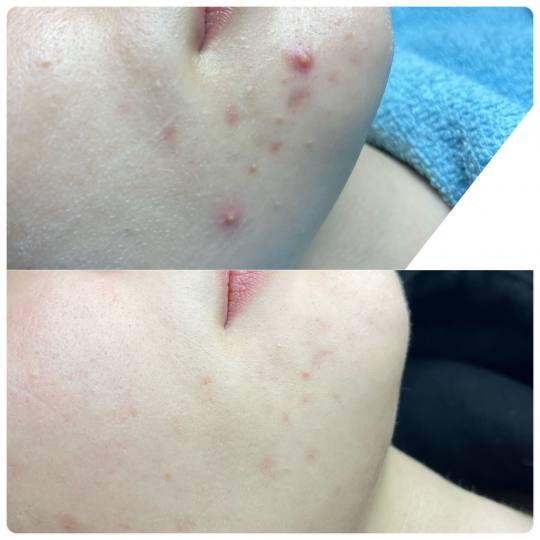 Lancier Beauty Expert #beograd Tretman lica Higijenski tretman + hidratacija + vitaminska bomba + po