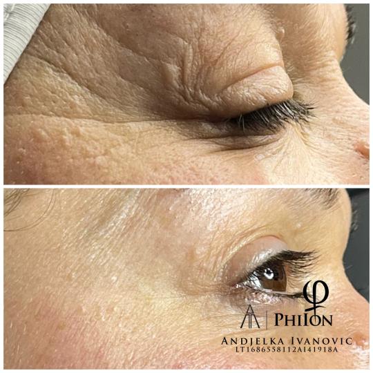 Belle Ana #beograd Tretman lica Microneedling tretman - lice