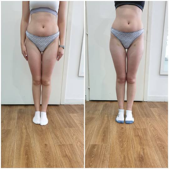 Brankica beauty artist #beograd Anticelulit masaža Maderoterapija Slika pre i posle 10 tretmana mad
