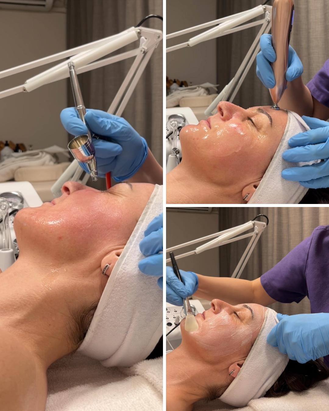 In line 1 #pancevo Tretmani protiv bora Oxygen i Plazma lift lica - zatezanje lica