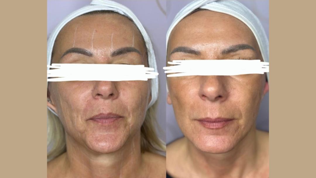 Hifu tretman - lice + vrat + dekolte - Attento Aesthetic, Beograd Radiotalasni i ultrazvučni tretmani Telo Radiotalasni i ultrazvučni tretmani, Beograd, Zvezdara