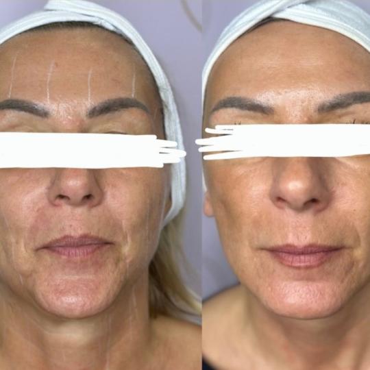 Attento Aesthetic #beograd Radiotalasni i ultrazvučni tretmani Hifu tretman - lice + vrat + dekolte