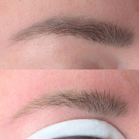 Brow & Glow #novisad Laserski tretmani lica Lasersko uklanjanje obrva