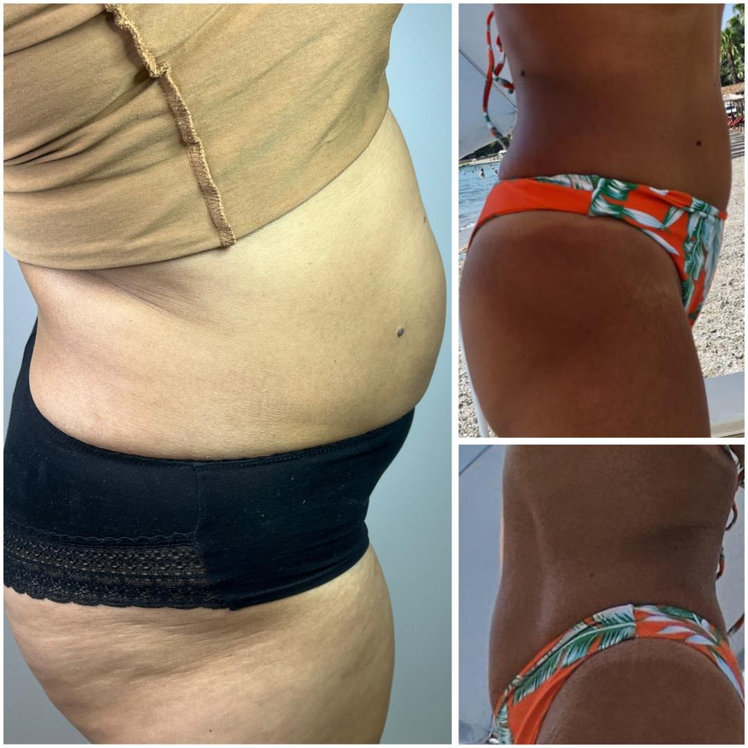 EMS tretman - 2 regije - Belle Ana, Beograd Tretmani tela Telo Tretmani tela, Beograd, Vračar, Čubura, Crveni krst