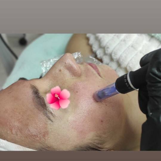 2 Cats 1 #beograd Dermaroler i dermapen Dermapen lice + vrat