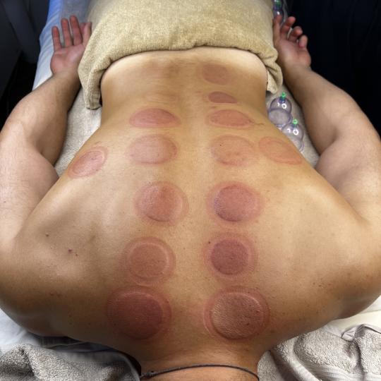 Zgodnica #beograd Tretmani tela Suva hidžama Suva hidžama je terapijska metoda koja koristi vakum 