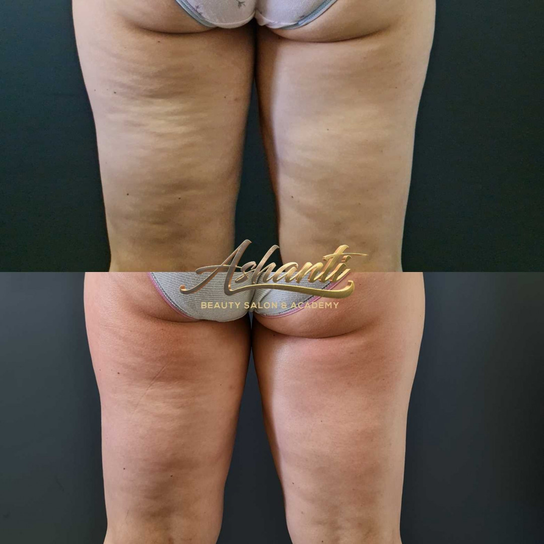 Ashanti Beauty Salon & Academy #beograd Masaža za mršavljenje Dermapen - regija lica