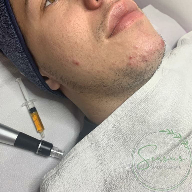 Sensus Zemun #beograd Dermaroler i dermapen Dermapen - za aknoznu kožu lica