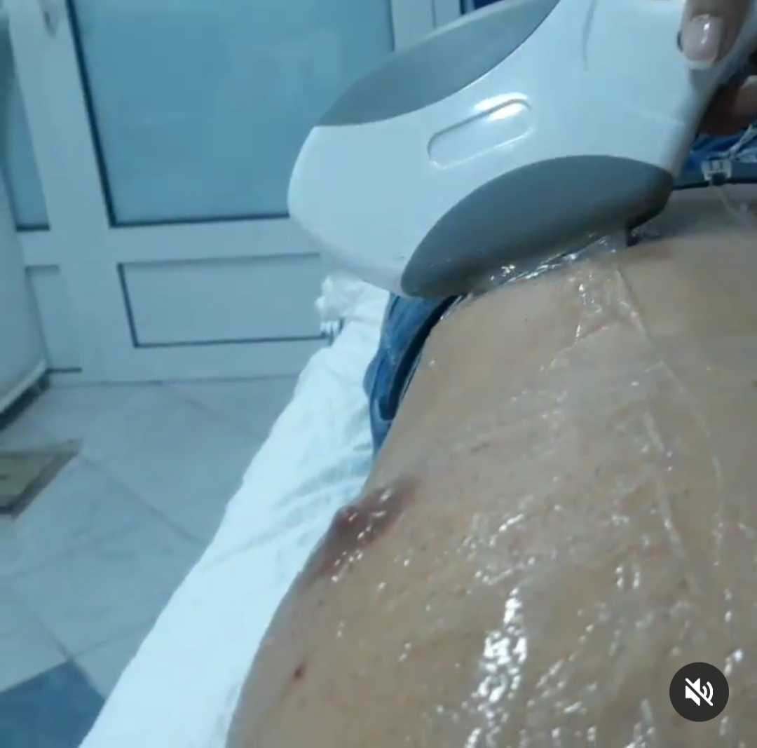AltaBella Batajnica #beograd Laserska epilacija Laserska epilacija grudi - za muškarce