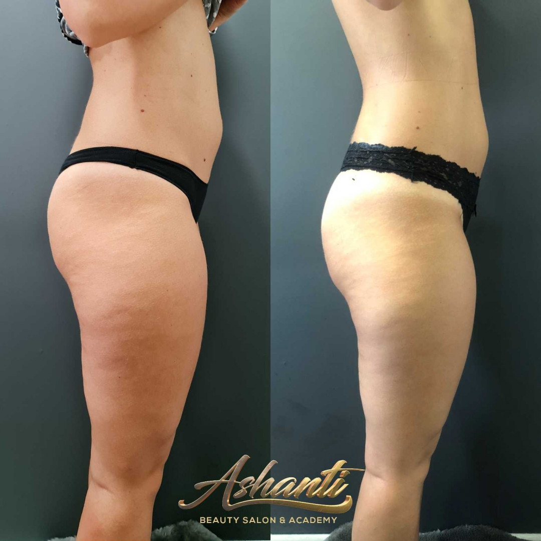 Ashanti Beauty Salon & Academy #beograd Masaža za mršavljenje Dermapen - regija lica