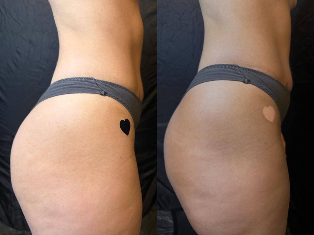 Metime lounge #beograd Air brush potamnjivanje kože Spray tan - celo telo i lice