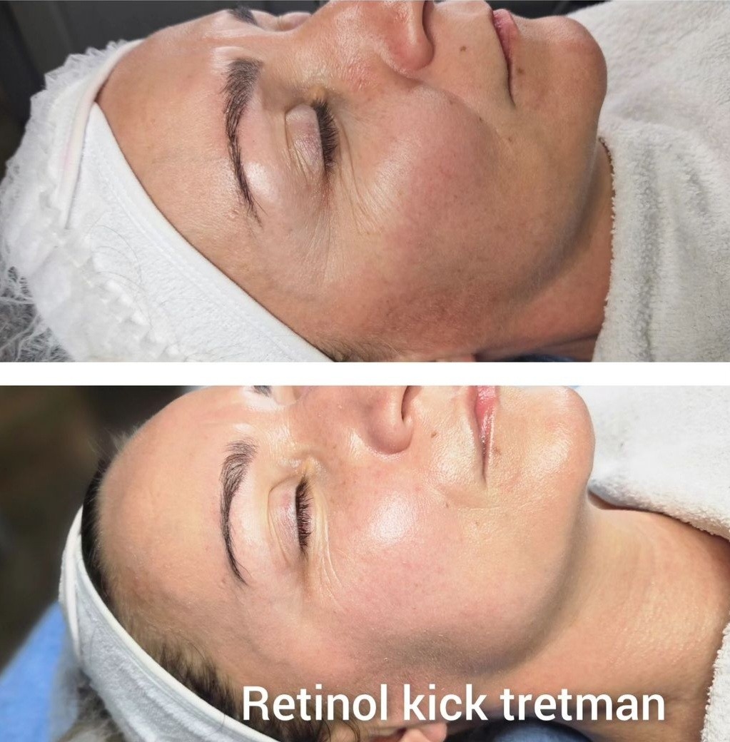 Beauty salon XL Lady #beograd Tretman lica Enzimski piling Retinol Kick - full tretman