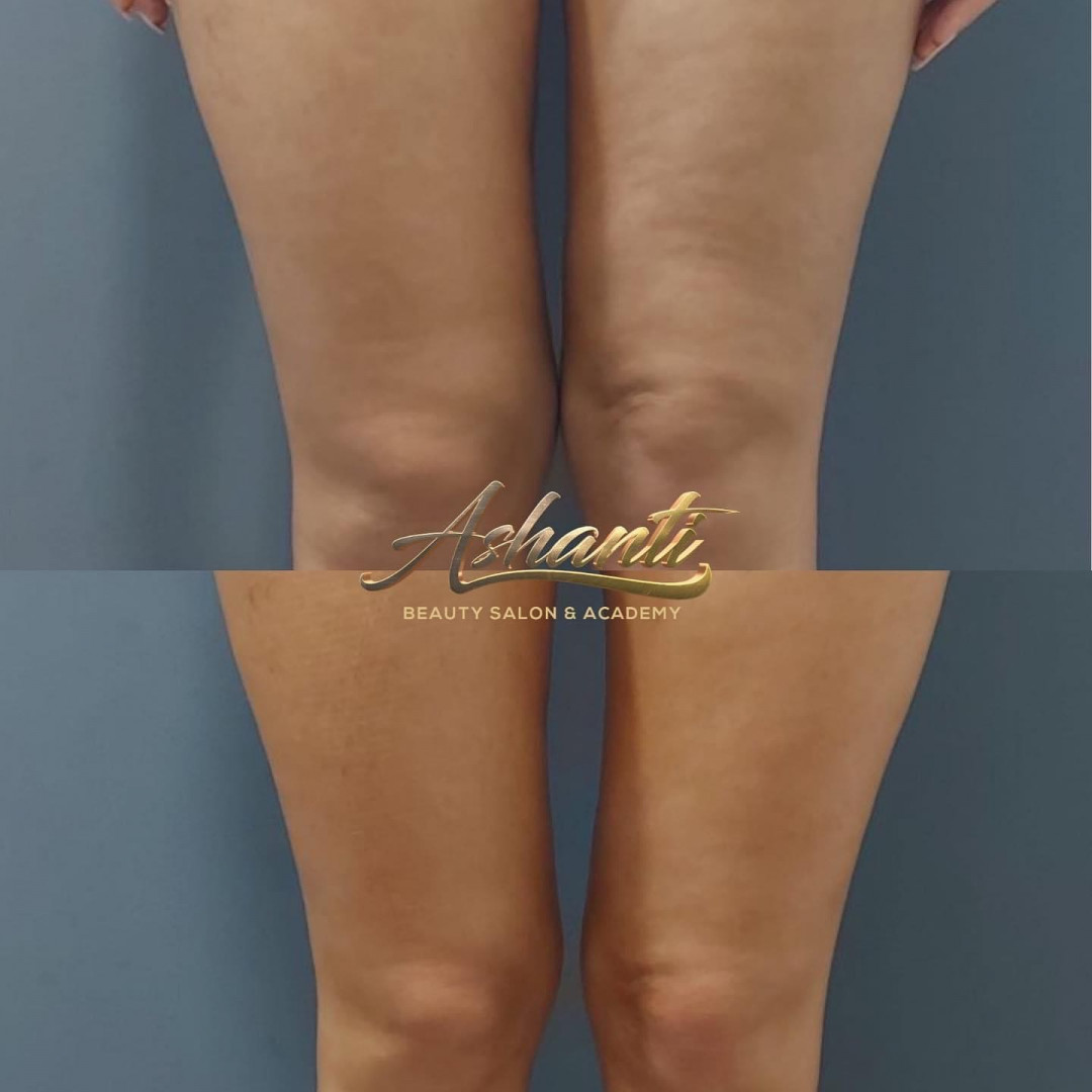 Ashanti Beauty Salon & Academy #beograd Masaža za mršavljenje Kolagen niti