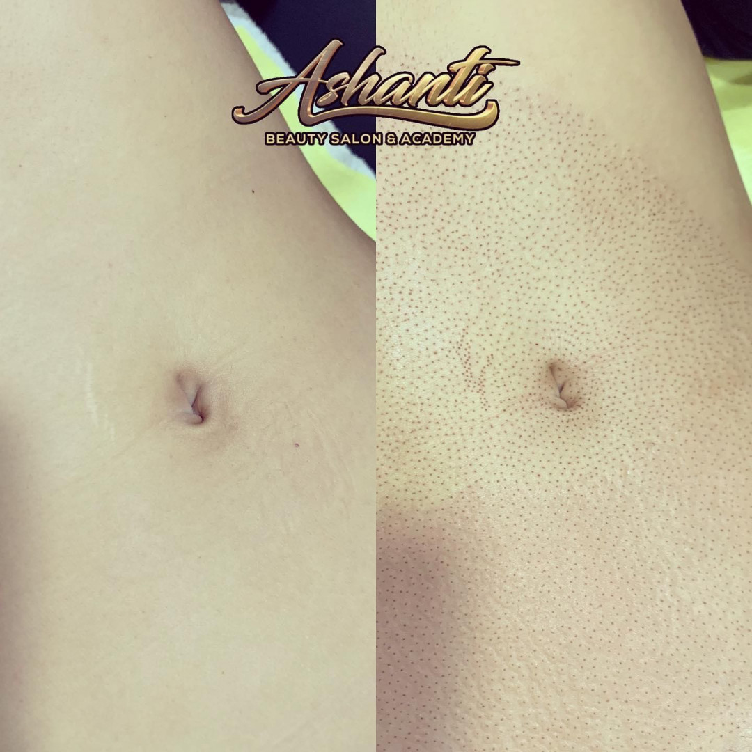 Plasma pen - stomak - Ashanti Beauty Salon & Academy, Beograd Tretman lica Lice Tretman lica, Beograd, Voždovac