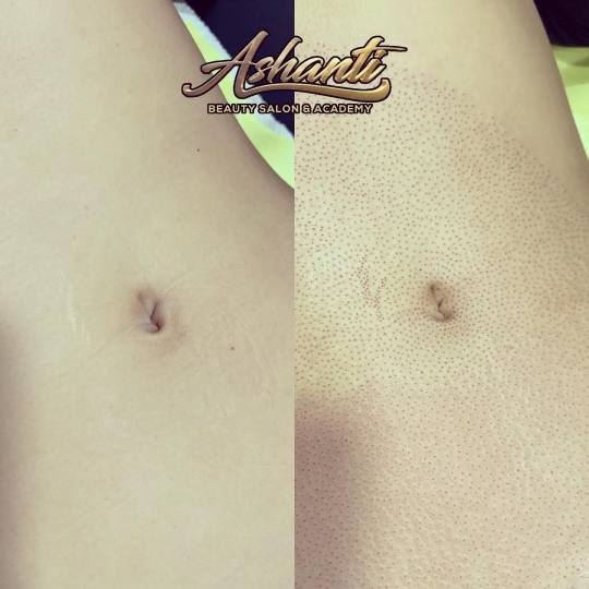Ashanti Beauty Salon & Academy #beograd Tretman lica Plasma pen - stomak