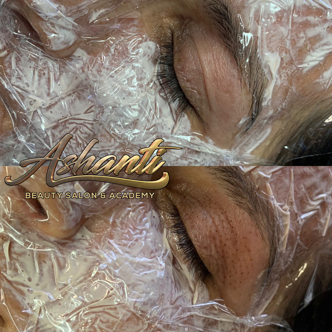 Plasma pen - celo lice - Ashanti Beauty Salon & Academy, Beograd Tretman lica Lice Tretman lica, Beograd, Voždovac