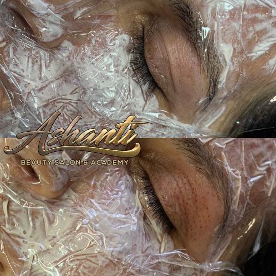 Ashanti Beauty Salon & Academy #beograd Tretman lica Plasma pen - celo lice
