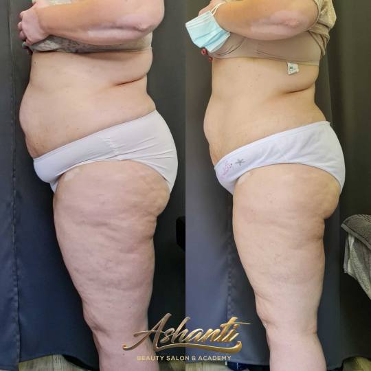Ashanti Beauty Salon & Academy #beograd Tretmani za mršavljenje Vacuslim 48 - noge + stomak + ruke 