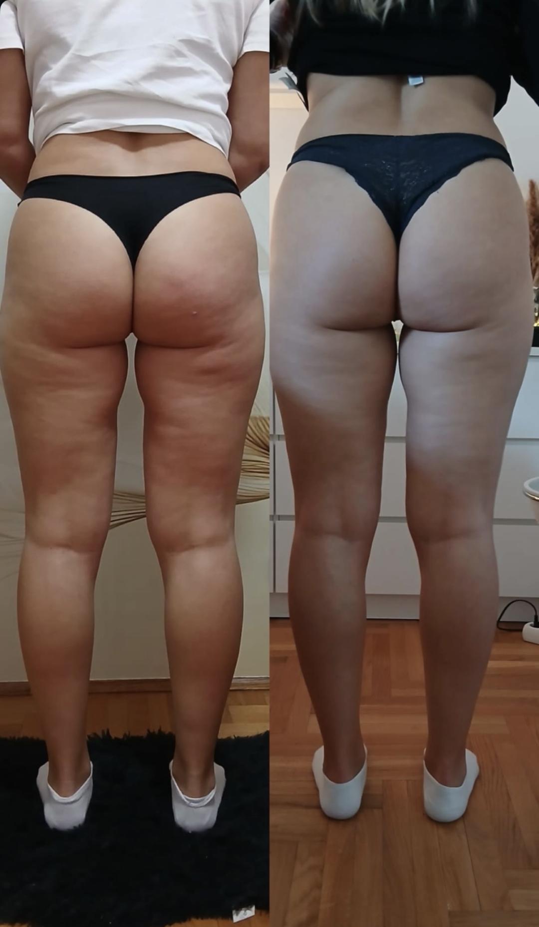 La Hermosa Beauty Studio #beograd Anticelulit masaža Vibraciona anticelulit masaza-paket od5tretmana