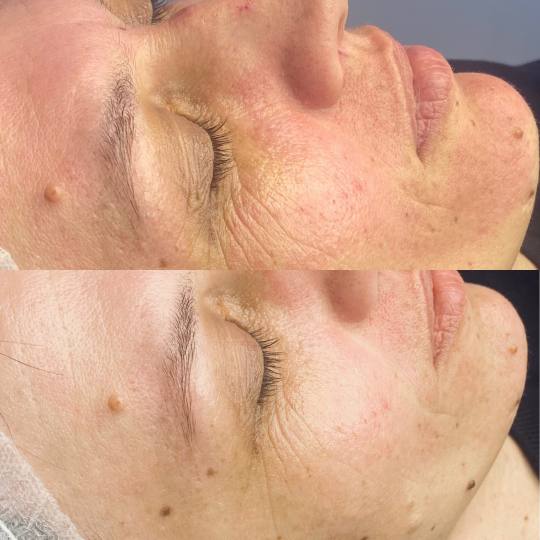 Beauty by Nevena Panić #beograd Tretman lica Winner filer tretman 100% prirodni hijaluronski fileri