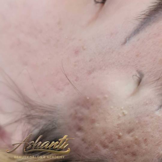 Ashanti Beauty Salon & Academy #beograd Dermaroler i dermapen Dermapen - celo lice
