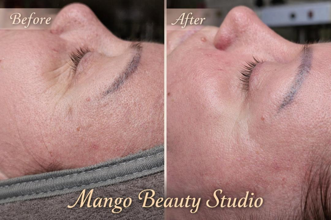 Dubinsko čišćenje lica (higijenski tretman+hidrodermoabrazija) - Mango beauty studio, Novi Sad Tretman lica Lice Tretman lica, Novi Sad, Telep, Adice, Bistrica