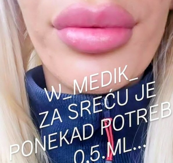 Petković Elite #beograd Make-up / šminkanje Botoks usana - 1ml filera
