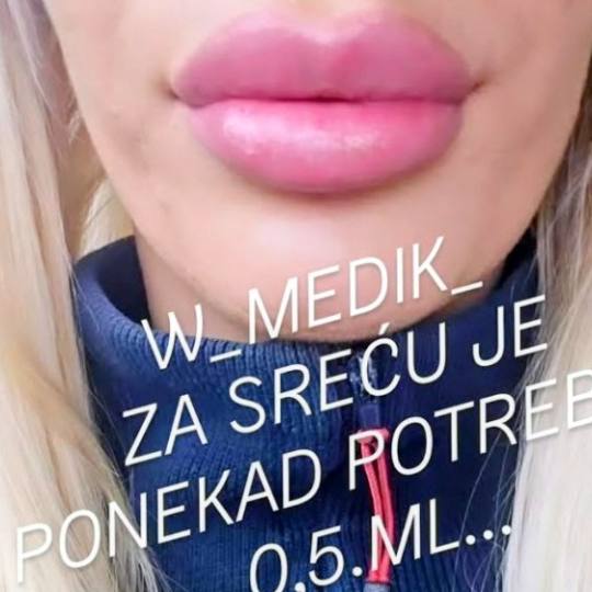 Petković Elite #beograd Make-up / šminkanje Botoks usana - 1ml filera Radimo sa Alergan /Revolex F