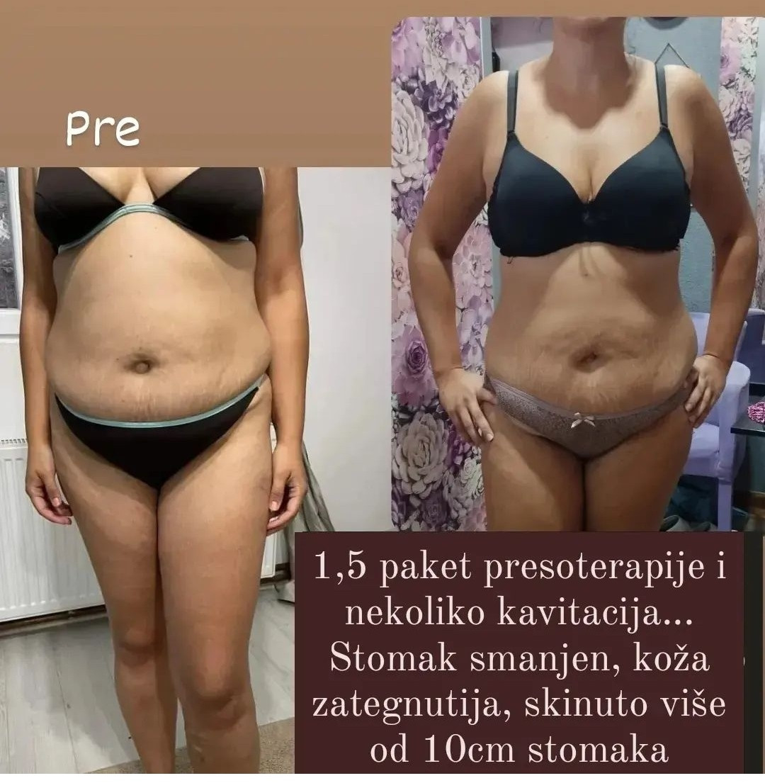 Ceragem Relax #krusevac Kavitacija Ultrazvučna kavitacija - stomak