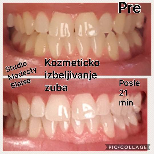 Studio Modesty Blaise #beograd Zubi Bezbolno, bez peroksida, bez ostecenja zubne gledji, posle samo 