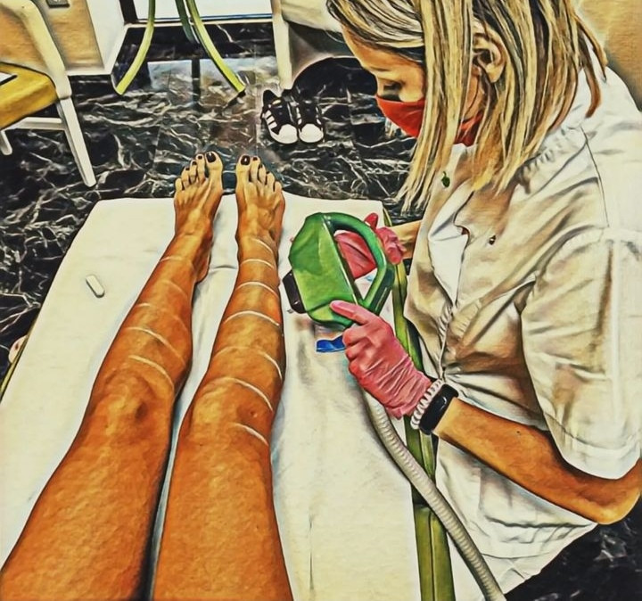 Epil Lux Centar #beograd Laserska epilacija Laserska epilacija celih nogu - za dame
