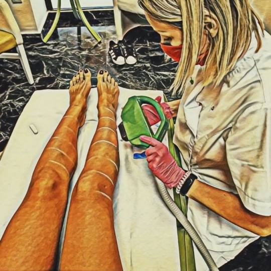 Epil Lux Centar #beograd Laserska epilacija Laserska epilacija celih nogu - za dame
