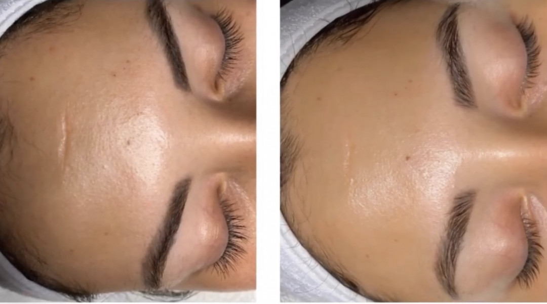 Zen Beauty #nis Hijaluronski tretmani lica Zen beauty Filler tretman