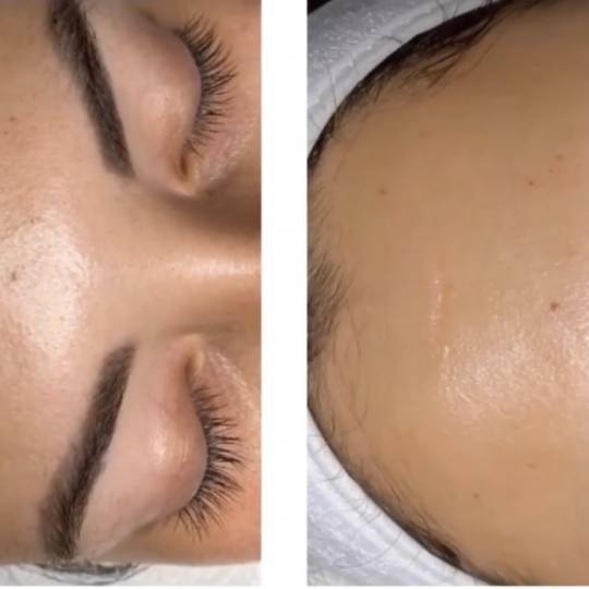 Zen Beauty #nis Hijaluronski tretmani lica Zen beauty Filler tretman