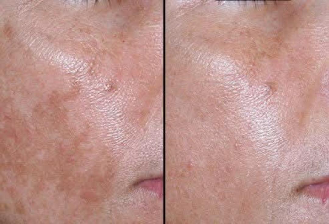 Tretman lica voćnim kiselinama - Astradas 2, Beograd Tretman lica Lice Tretman lica, Beograd, Novi Beograd blokovi, Belville, Savski kej