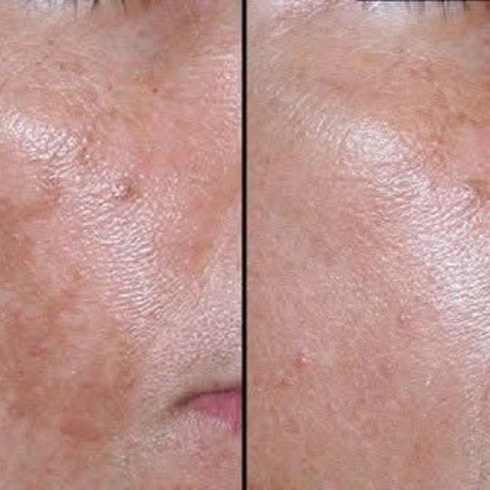 Astradas 2 #beograd Tretman lica Tretman lica voćnim kiselinama