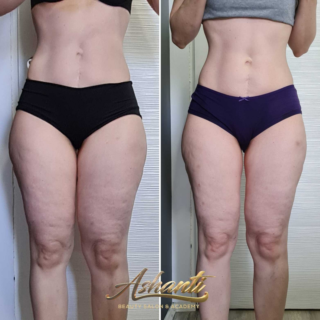 Ashanti Beauty Salon & Academy #beograd Masaža za mršavljenje Dermapen - regija lica