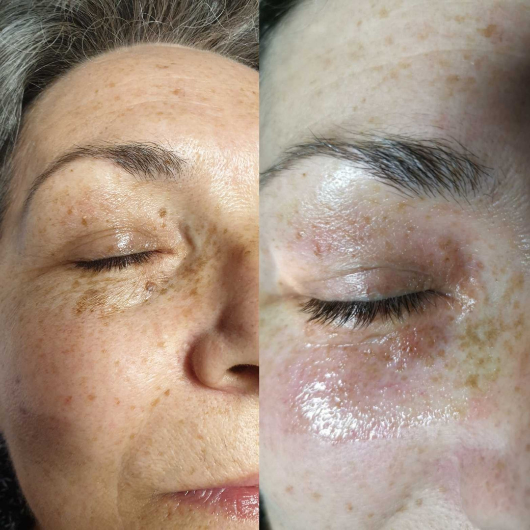 Grossi cosmetic #beograd Tretman lica