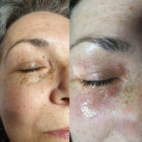 Grossi cosmetic #beograd Tretman lica