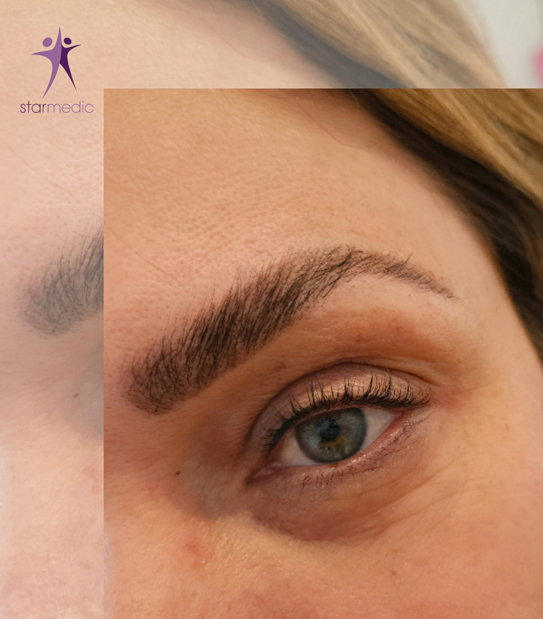 Starmedic #beograd Trepavice Brow lift