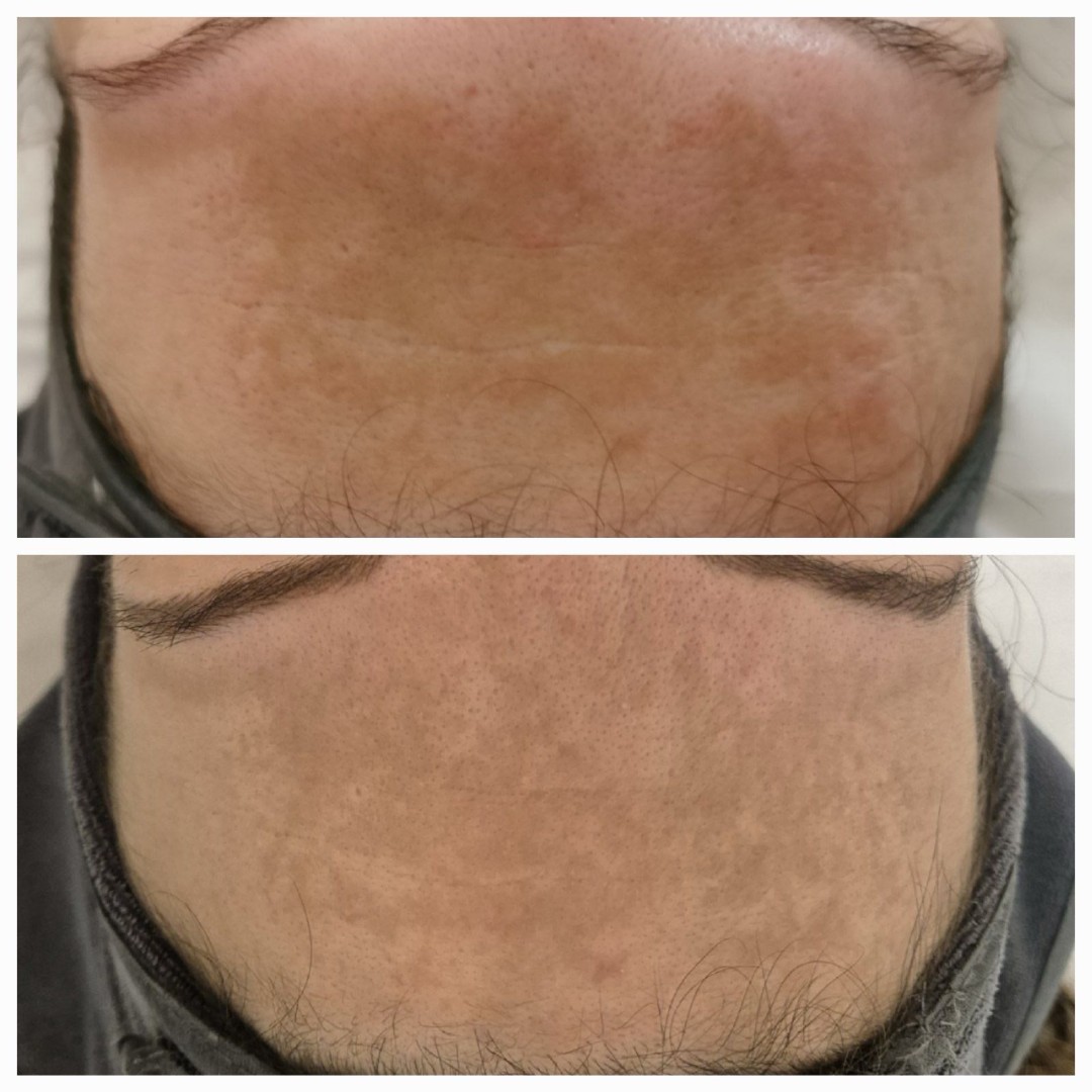 Happy Lady #beograd Tretman lica White up + Peptide peel tretman - za kožu sa pigmentacijama / melazmom
