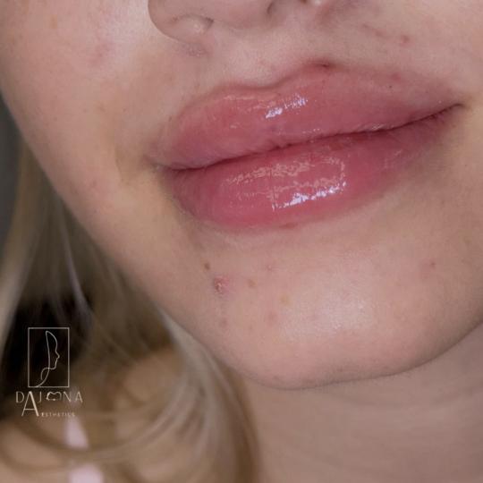 DajanaAesthetics #novisad Dermalni fileri Korekcija usana -1ml Radiant filera