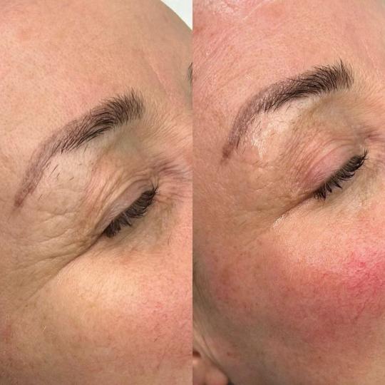 Beauty Glam House #nis Tretmani protiv bora Hifu tretman - lice HIFU (High Intensity Focused Ultraso